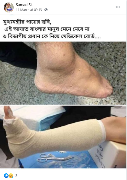 mamata leg claim.png